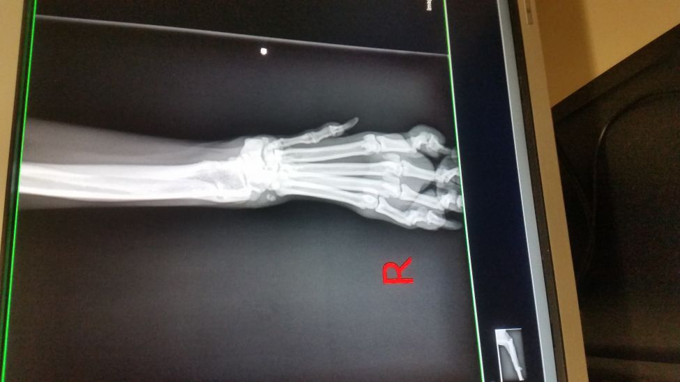 This is the xray of buddy leg